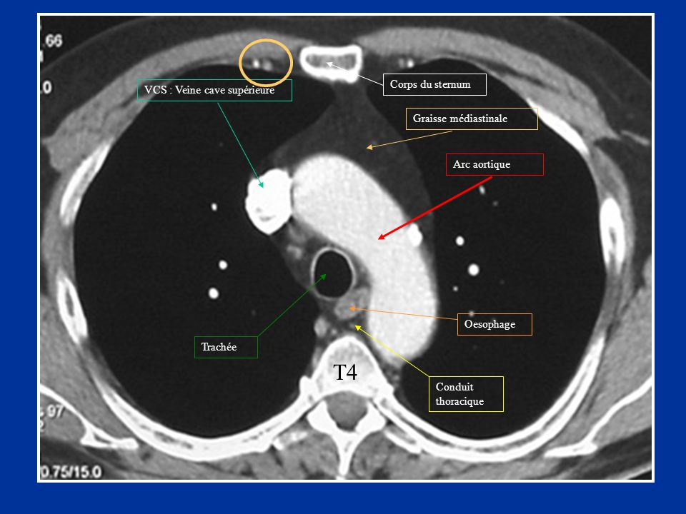 T4+Corps+du+sternum+VCS+-+Veine+cave+supérieure+Graisse+médiastinale.jpg